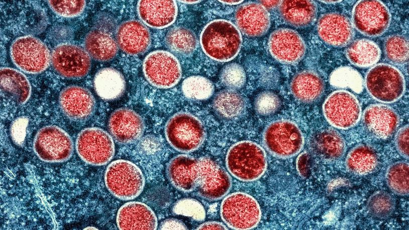 FILE - This undated image provided by the National Institute of Allergy and Infectious Diseases shows a colorized transmission electron micrograph of monkeypox particles (red) found within an infected cell (blue), cultured in the laboratory that was captured and color-enhanced at the NIAID Integrated Research Facility in Fort Detrick, Md. (NIAID via AP, File)