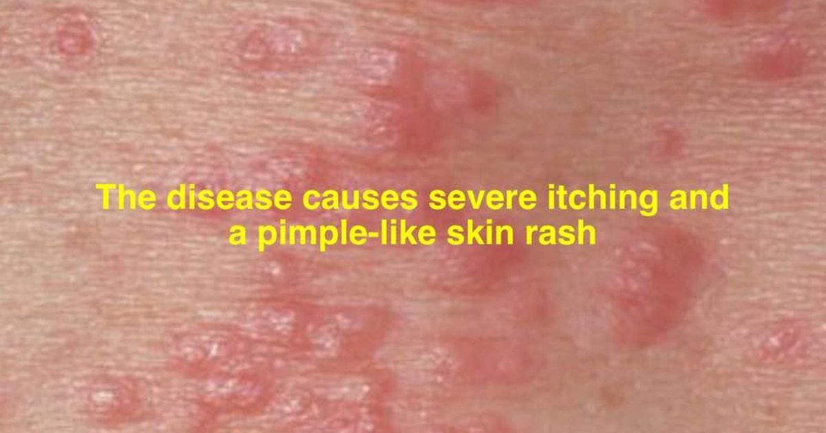 Scabies outbreak at Kettering Medical Center l Dayton, Ohio