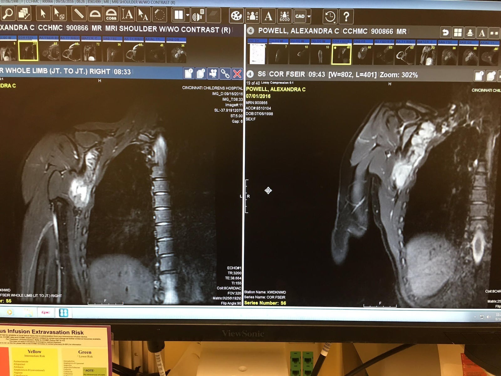 MRI showing desmoid tumor in Alex Powell’s right shoulder. CONTRIBUTED