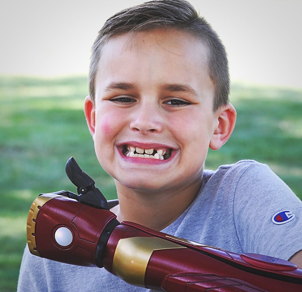 Boy has 'Iron Man' arm