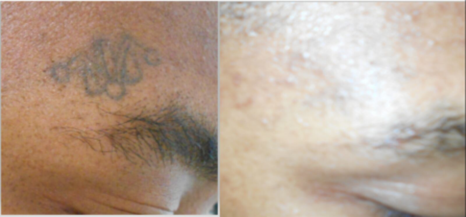 Before and after photo highlighting an Ohio inmate's tattoo removal. The program is a relatively new offering for the Ohio Department Department of Rehabilitation and Correction.