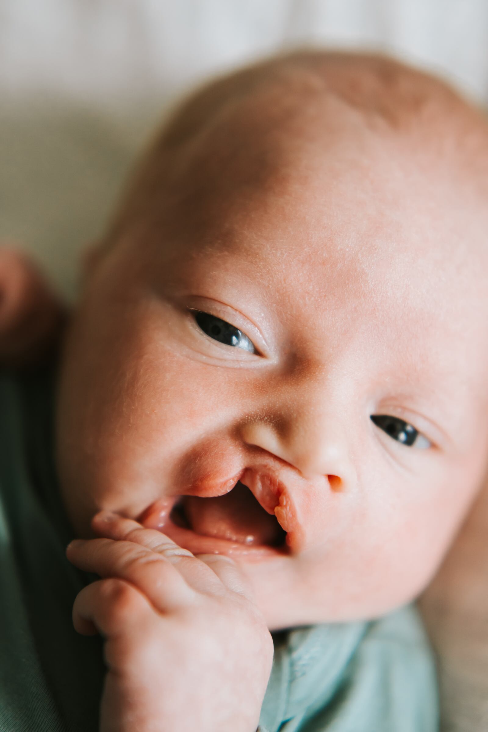 Case Lauf, of Springboro, before his surgery at Shriners Children's Ohio. Case was born with a cleft lip. CONTRIBUTED