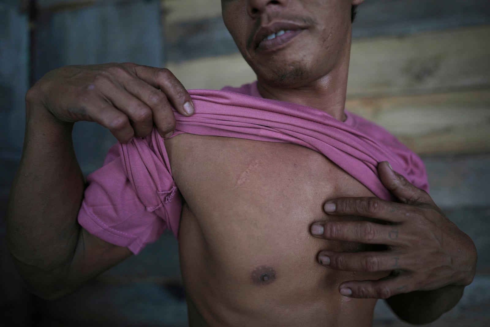 Suardi, a crocodile attack survivor, shows a scar on his chest in Budong-Budong, West Sulawesi, Indonesia, Monday, Feb. 24, 2025. (AP Photo/Dita Alangkara)