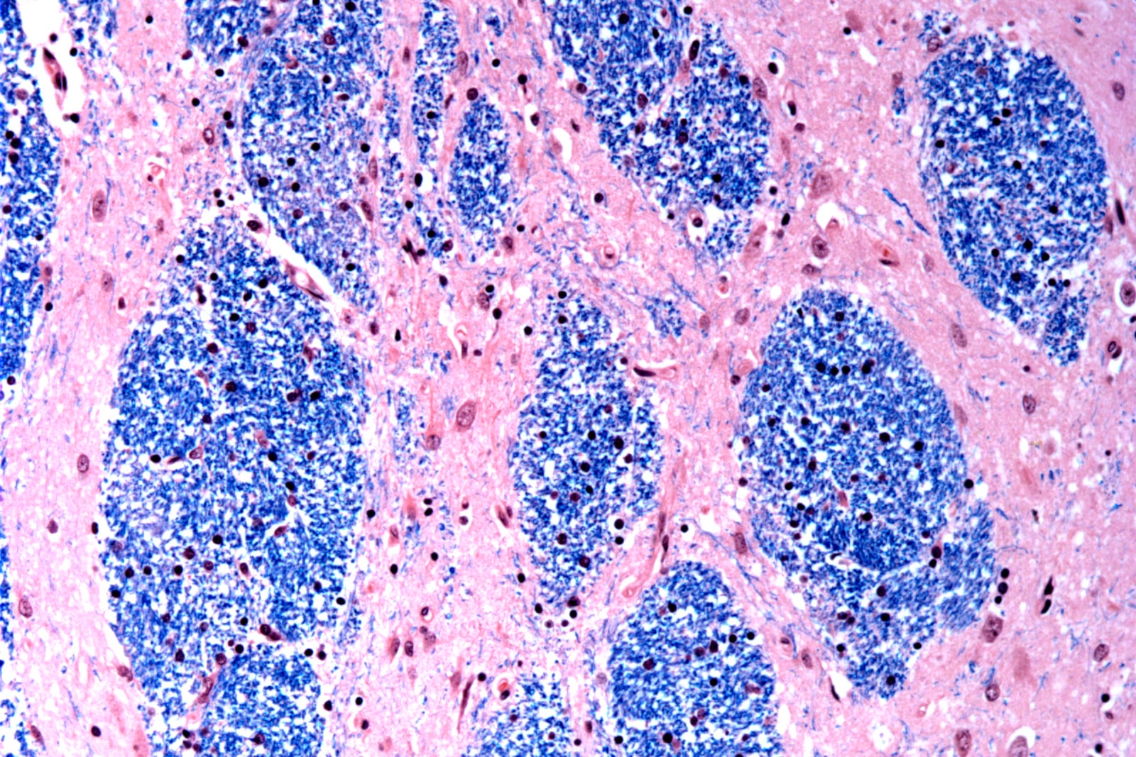 This microscope photo provided by the McLean Hospital's Harvard Brain Tissue Resource Center in January 2024 shows cells in the caudate nucleus structure of the brain in a person with Huntington's disease. (McLean Hospital's Harvard Brain Tissue Resource Center/NIH NeuroBioBank via AP)