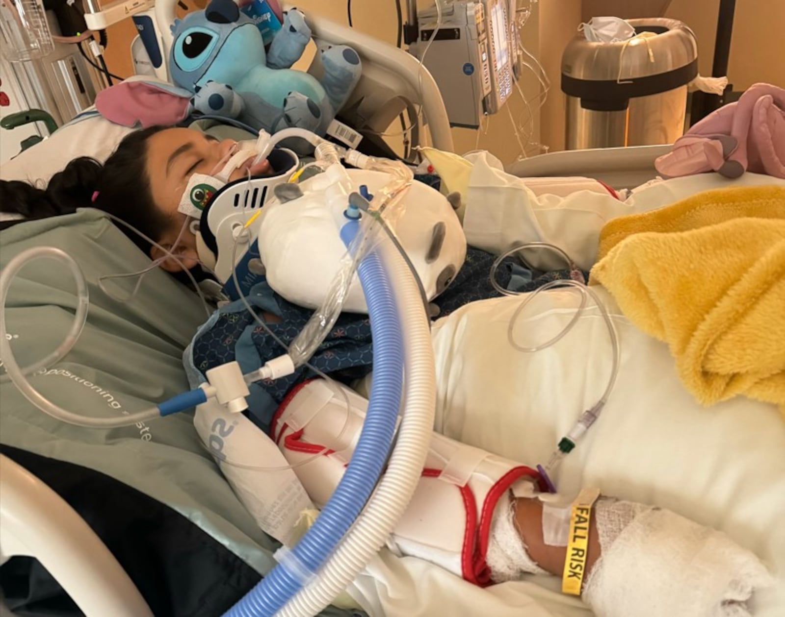 Ashley Escalante, 9, of Dayton, was in a coma for 10 days and hospitalized for 50 days after she was struck by an SUV on Wayne Avenue in Dayton on July 22, 2024. Police say it was a hit-and-run and the driver was drunk and later arrested and charged with multiple felonies. CONTRIBUTED