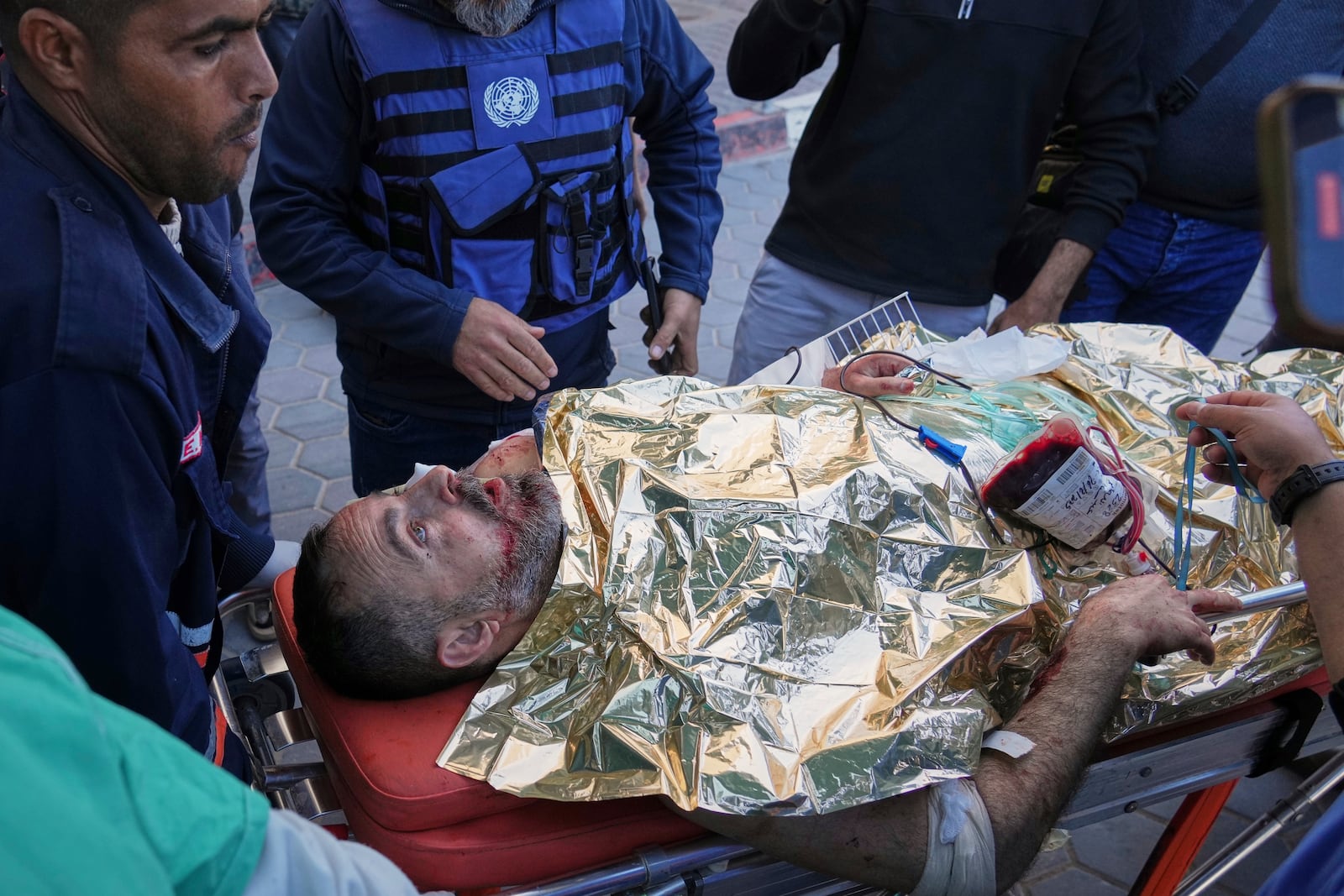 An injured United Nations Mine Action Service (UNMAS) worker is brought into al-Aqsa Martyrs Hospital following what the U.N. described as a strike in which an explosive ordnance was "dropped or fired" in Deir al-Balah, central Gaza, Wednesday, March 19, 2025. (AP Photo/Abdel Kareem Hana)