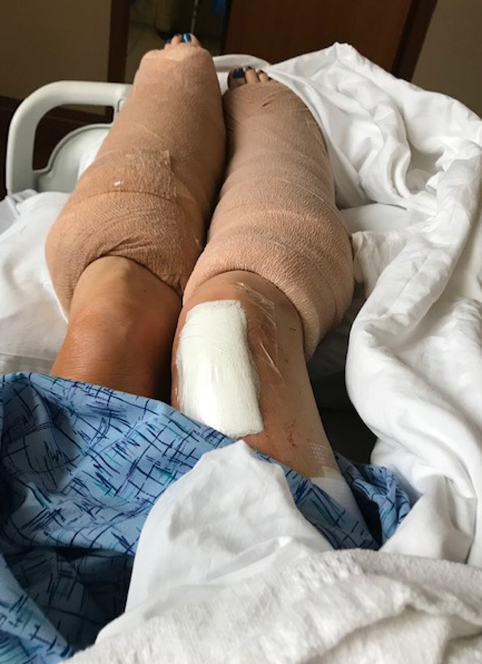 Deborah Wailes' legs after surgery in 2019. CONTRIBUTED